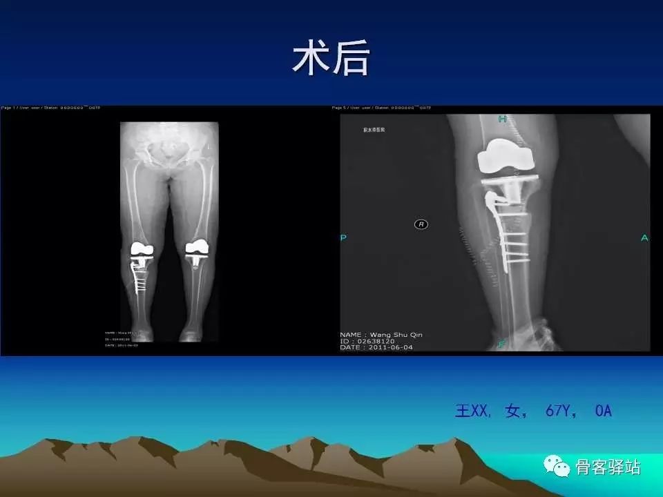 复杂性膝关节置换术的处理策略