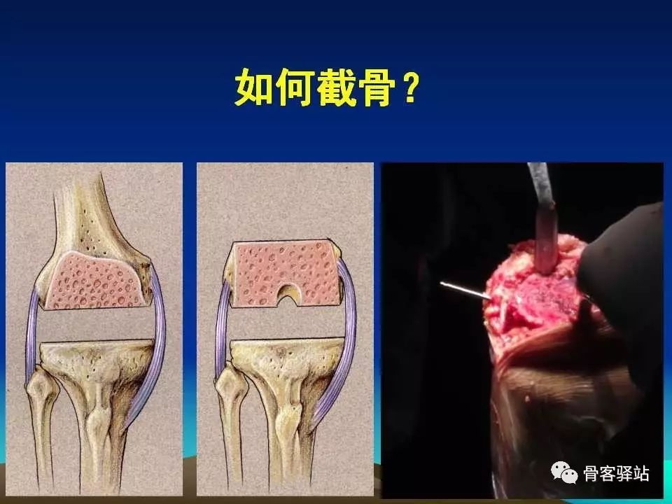 复杂性膝关节置换术的处理策略