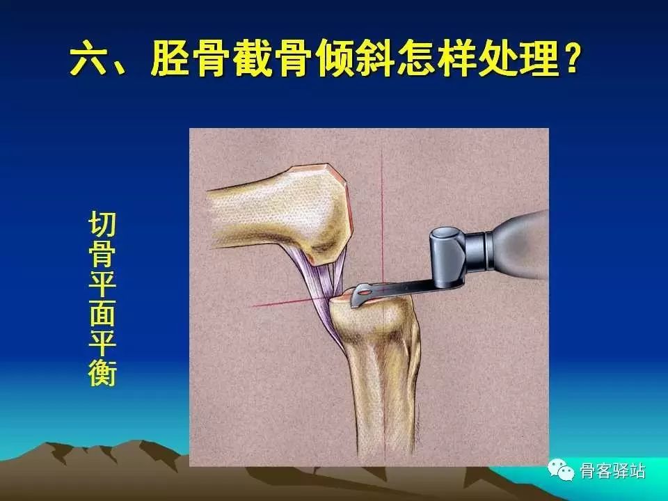 复杂性膝关节置换术的处理策略