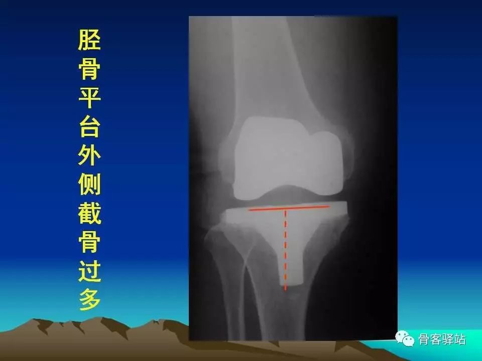 复杂性膝关节置换术的处理策略