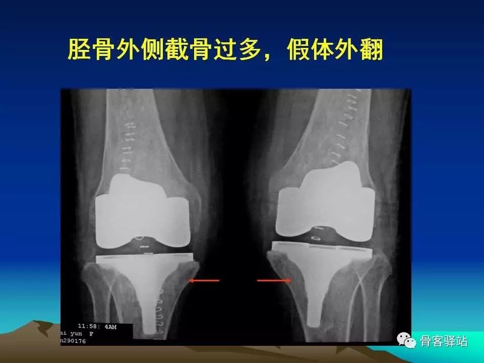 复杂性膝关节置换术的处理策略