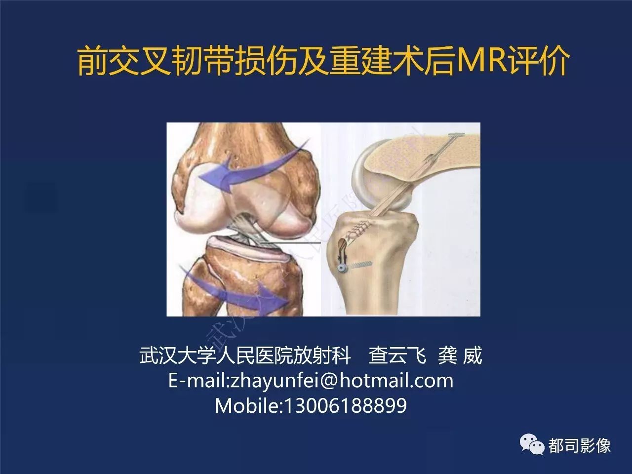 前交叉韧带损伤及重建术后的MR评价