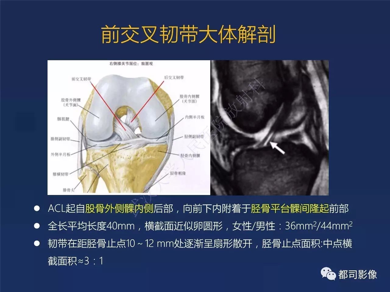 前交叉韧带损伤及重建术后的MR评价