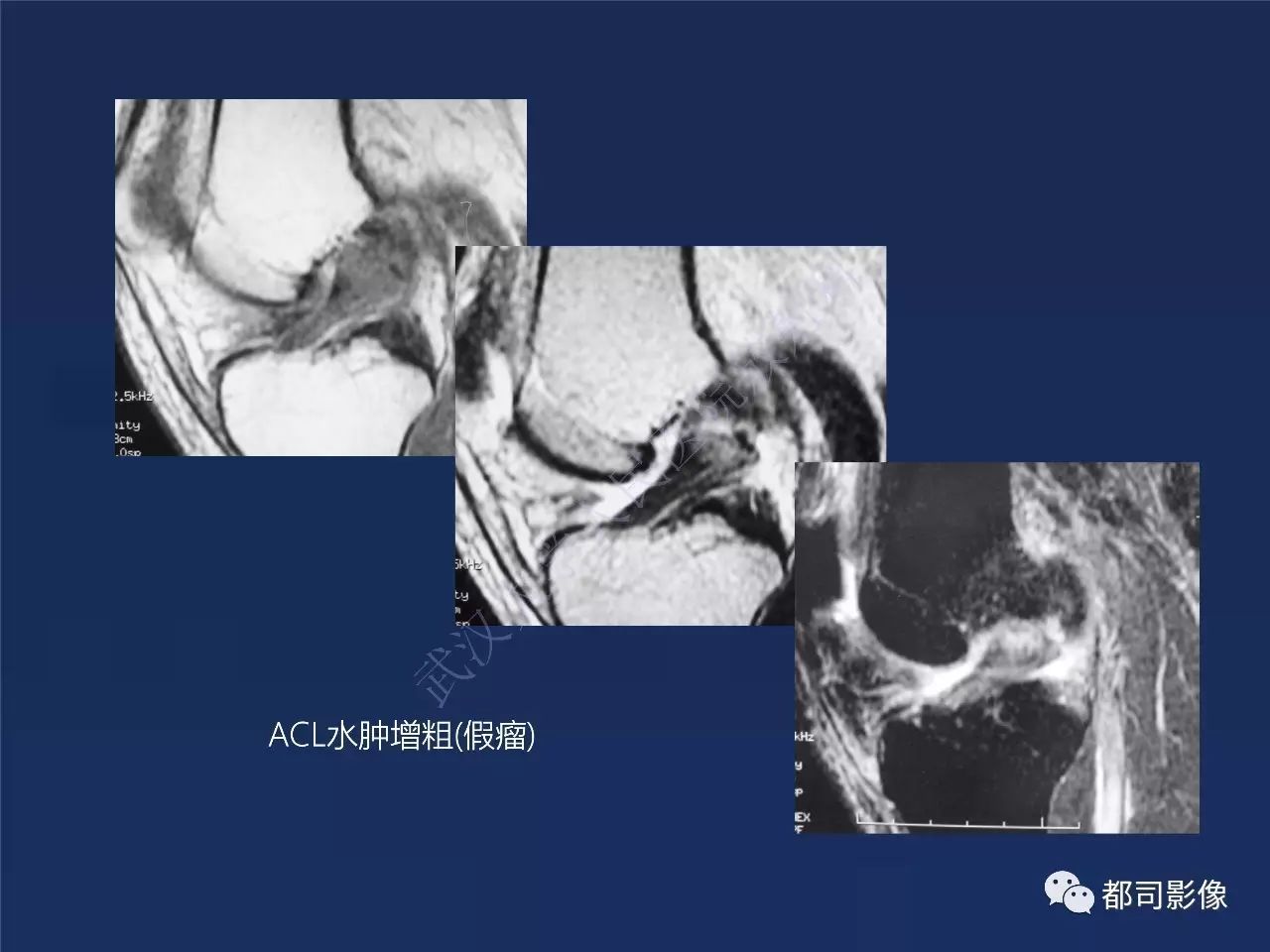 前交叉韧带损伤及重建术后的MR评价