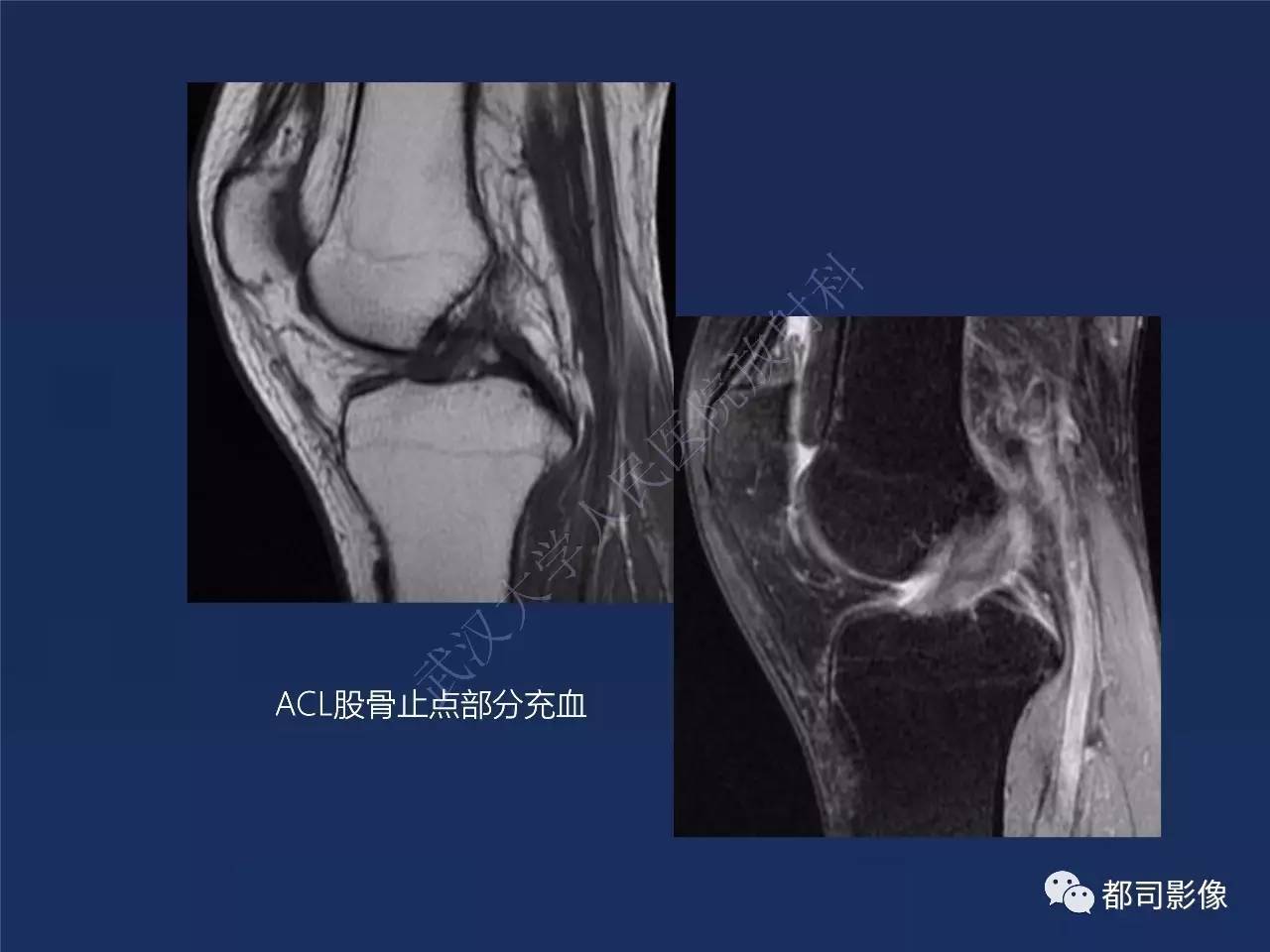 前交叉韧带损伤及重建术后的MR评价