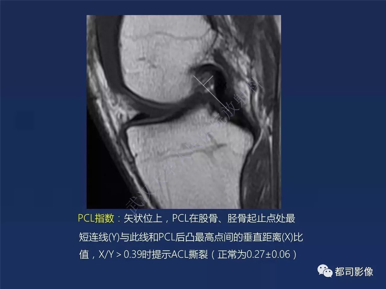 前交叉韧带损伤及重建术后的MR评价