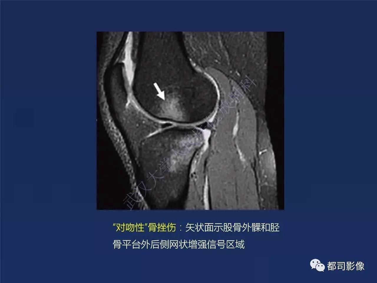 前交叉韧带损伤及重建术后的MR评价