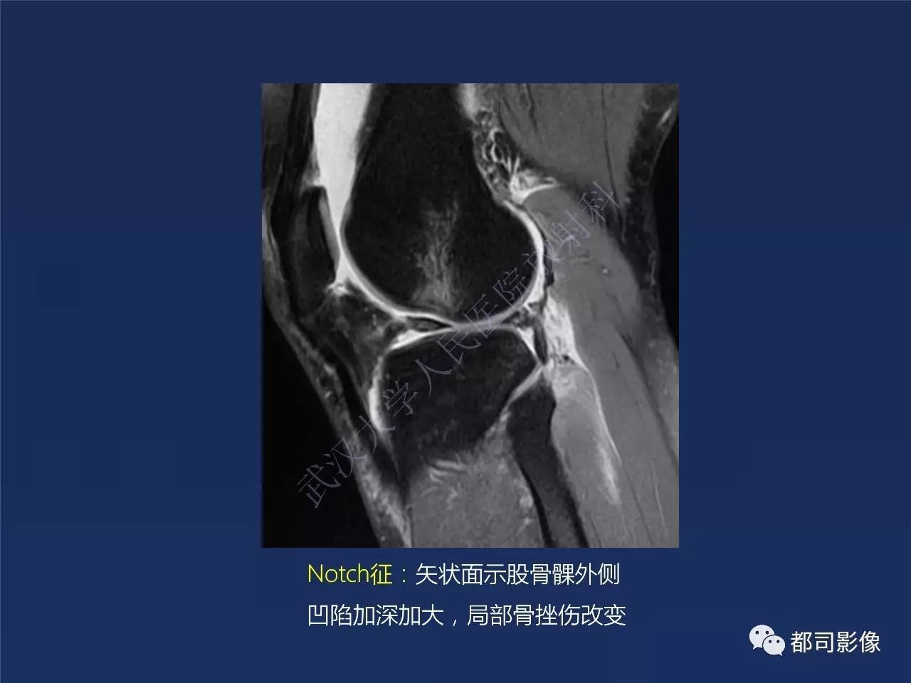 前交叉韧带损伤及重建术后的MR评价