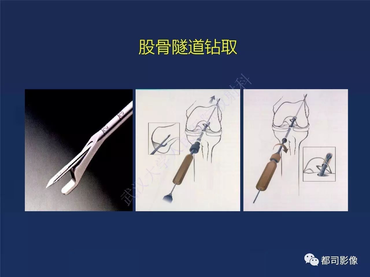 前交叉韧带损伤及重建术后的MR评价