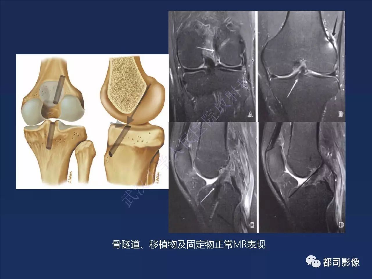 前交叉韧带损伤及重建术后的MR评价