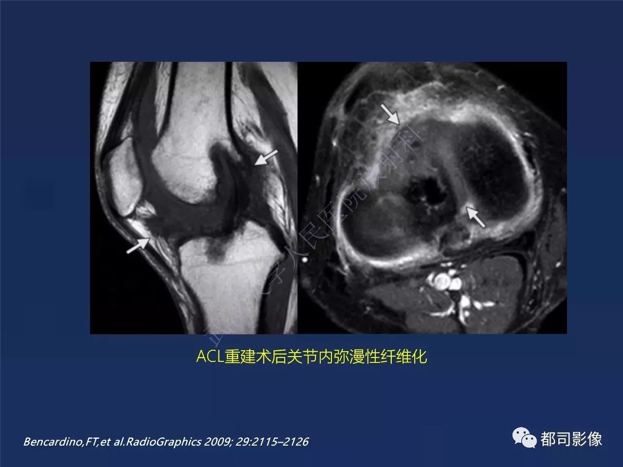 前交叉韧带损伤及重建术后的MR评价