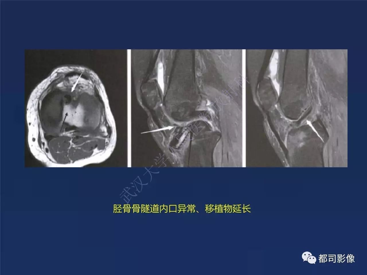 前交叉韧带损伤及重建术后的MR评价