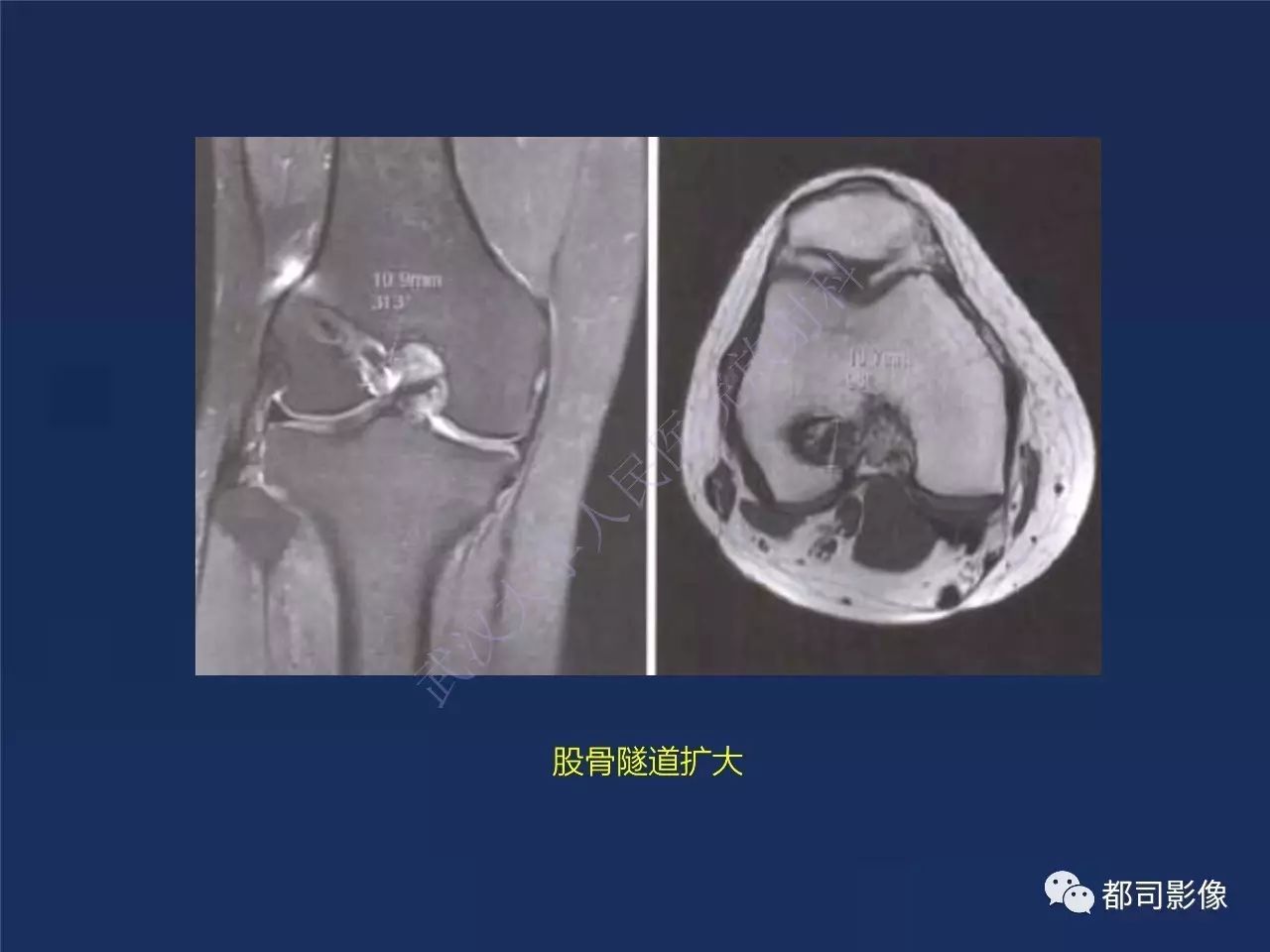 前交叉韧带损伤及重建术后的MR评价