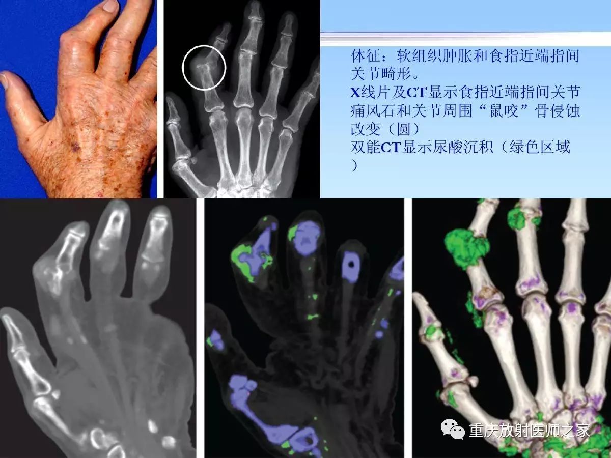 痛风性关节炎的影像诊断及进展