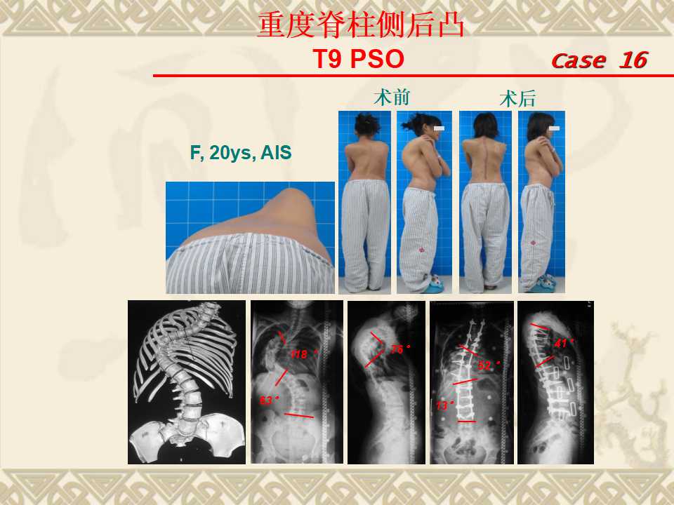 脊柱侧弯的治疗方法及对策