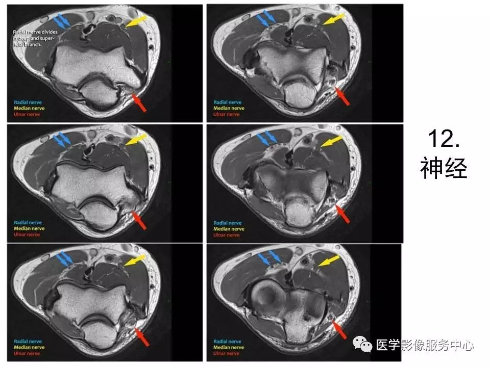 目前关于肘关节MRI讲解的最好ppt，值得一看！