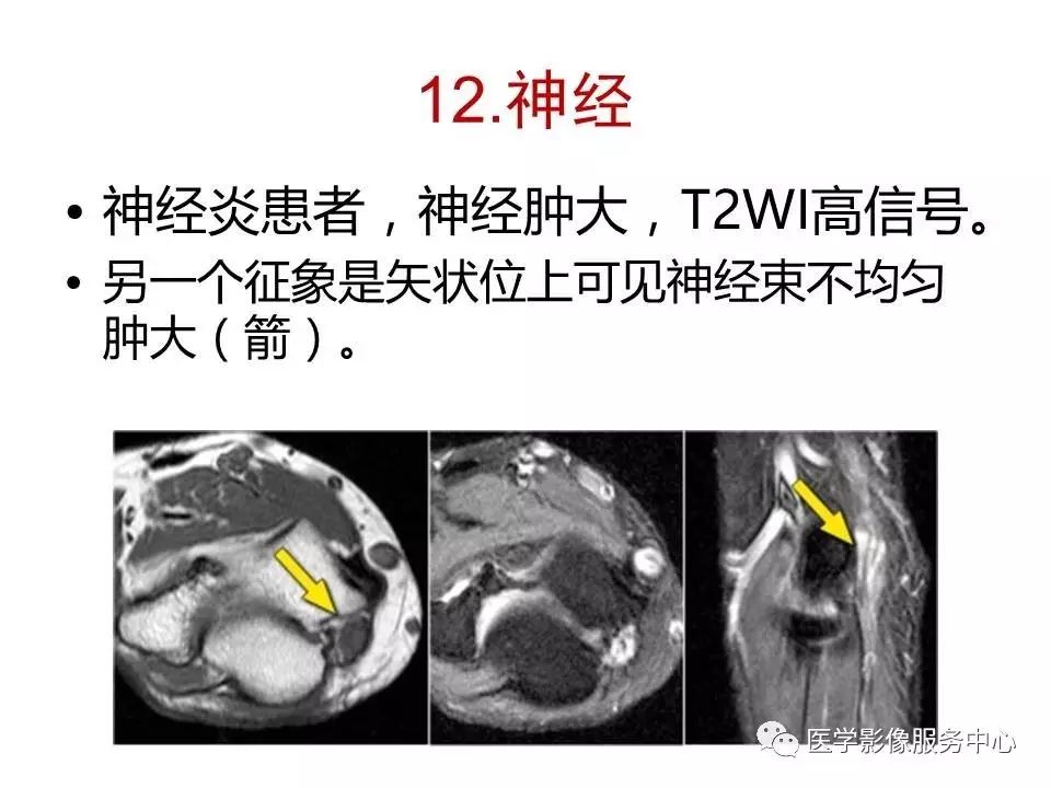 目前关于肘关节MRI讲解的最好ppt，值得一看！