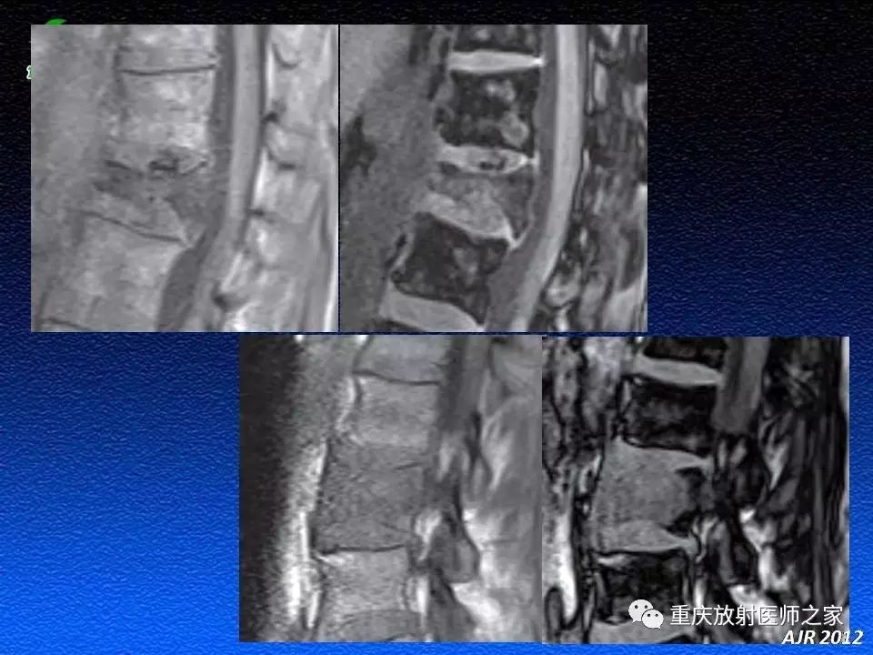 椎体良恶性压缩骨折的影像鉴别