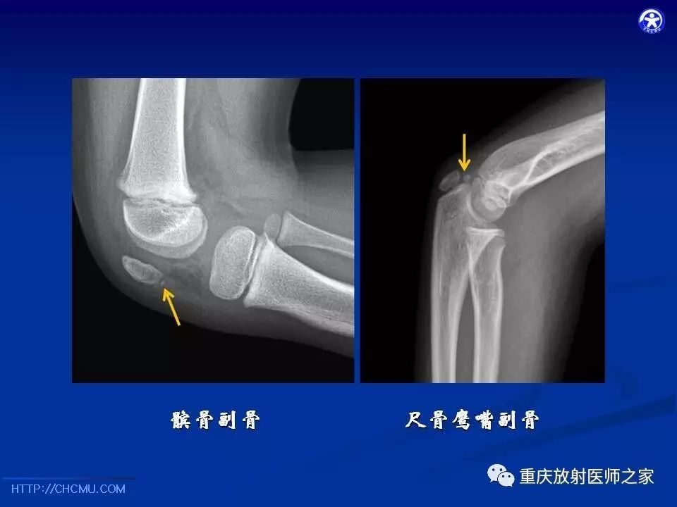 儿童骨创伤的影像学诊断