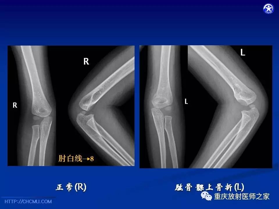 儿童骨创伤的影像学诊断