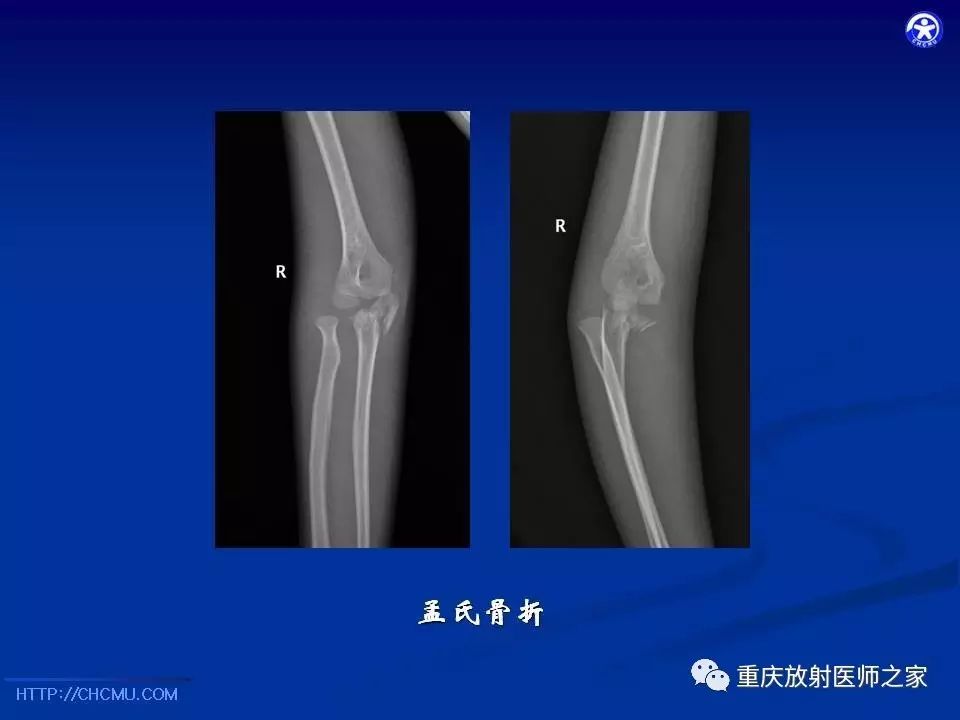 儿童骨创伤的影像学诊断