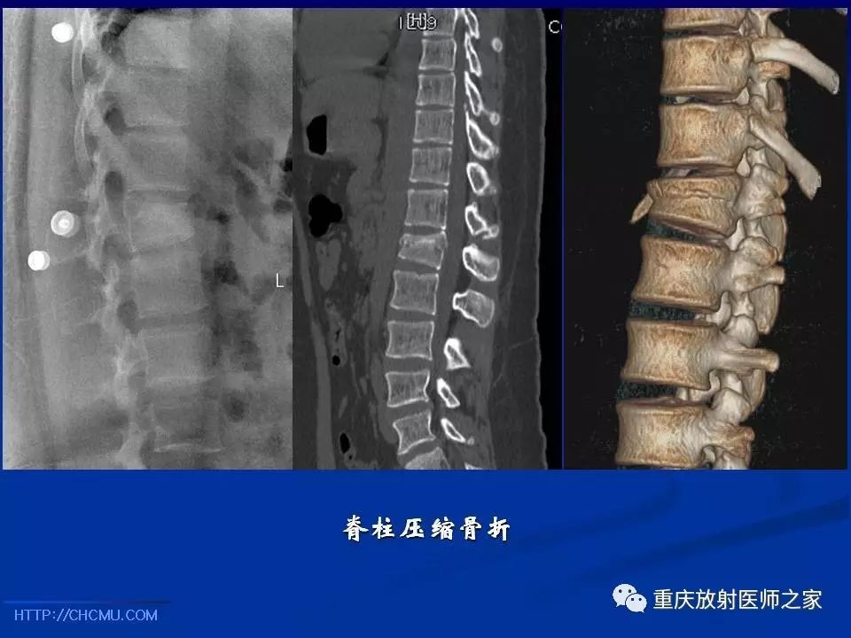 儿童骨创伤的影像学诊断