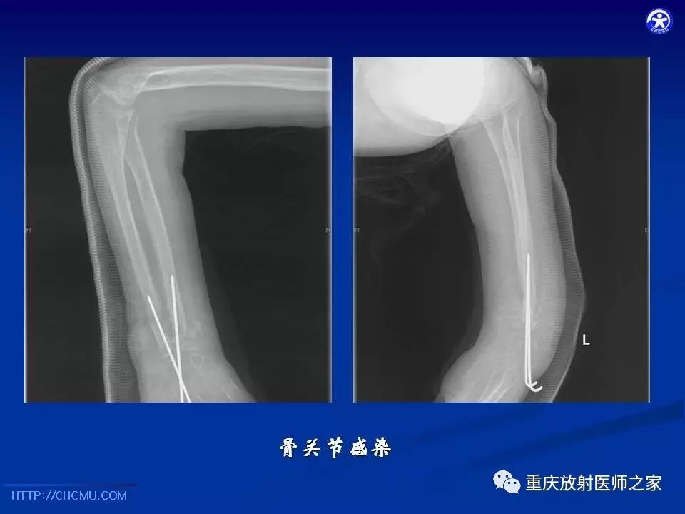 儿童骨创伤的影像学诊断