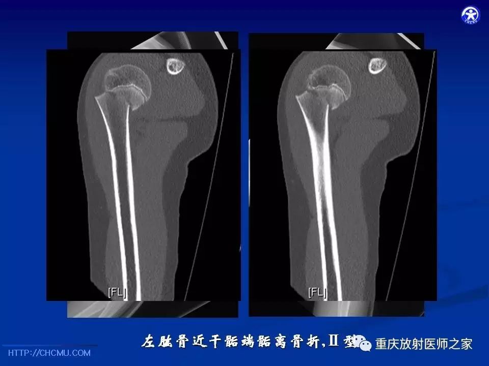 儿童骨创伤的影像学诊断