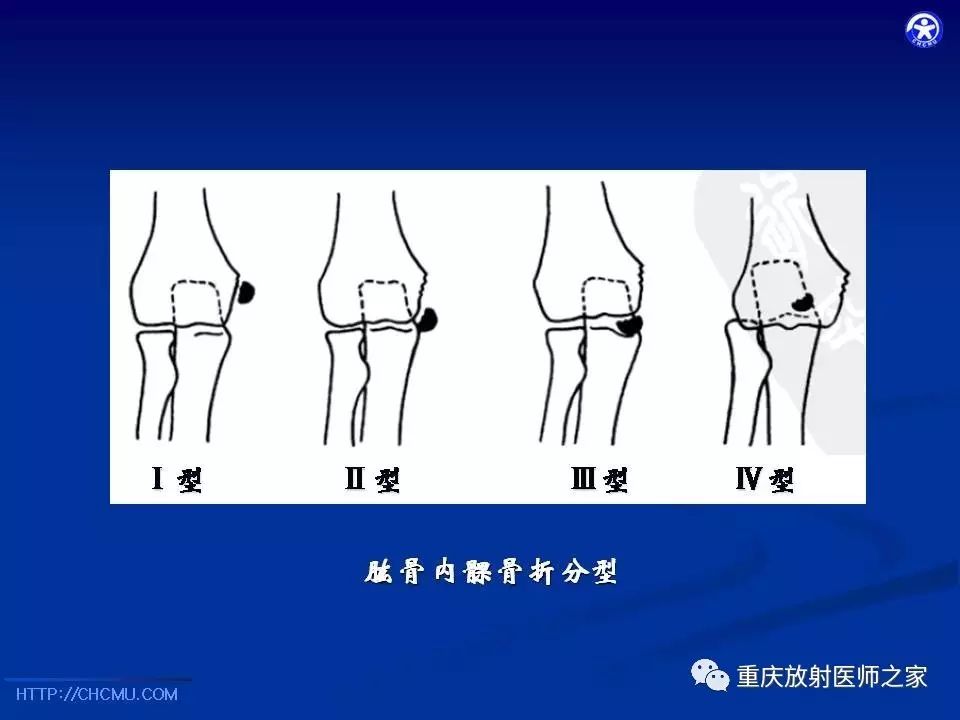 儿童骨创伤的影像学诊断