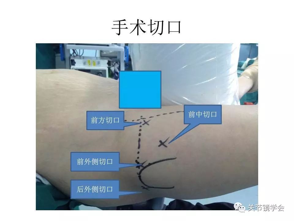 揭秘髋关节镜的手术过程