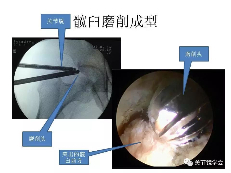 揭秘髋关节镜的手术过程