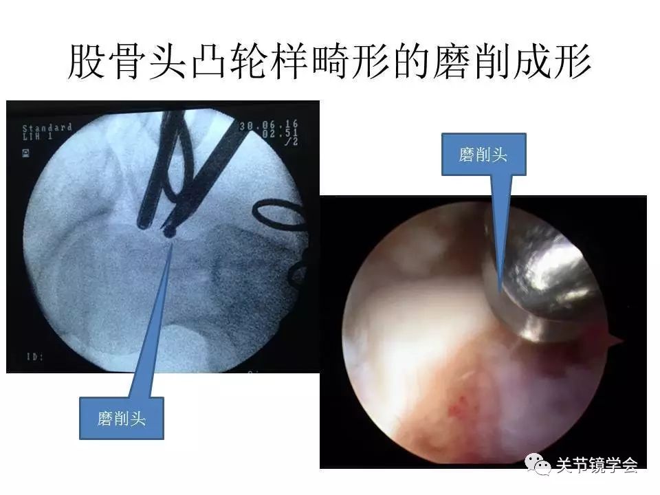 揭秘髋关节镜的手术过程