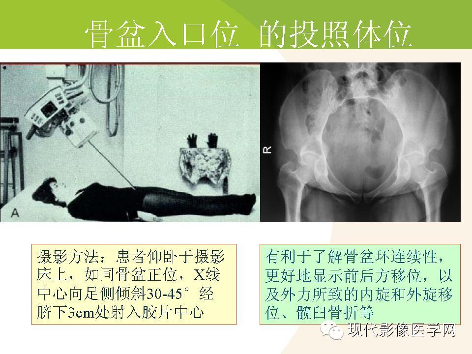 骨盆与髋臼创伤的影像诊断基础