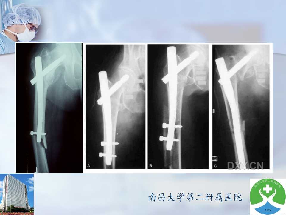 股骨转子间骨折内固定治疗的要点