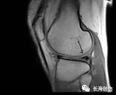 半月板损伤的检查及临床治疗