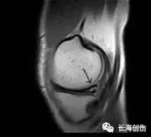 半月板损伤的检查及临床治疗