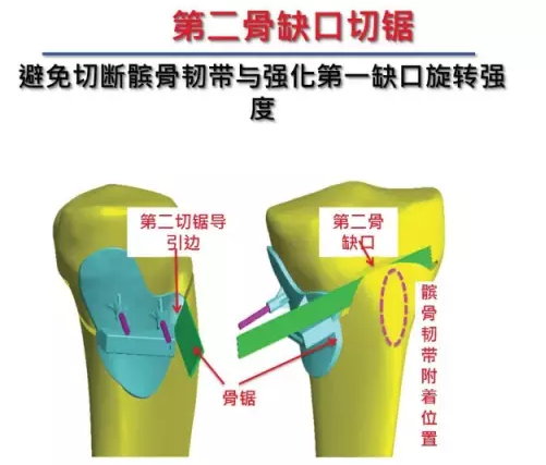 胫骨高位截骨术(HTO)治疗膝关节骨关节炎