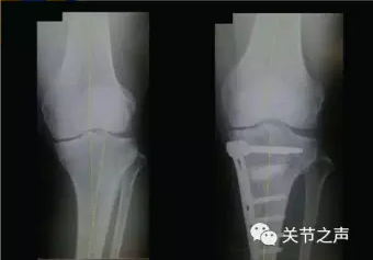 胫骨高位截骨术(HTO)治疗膝关节骨关节炎