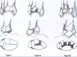 Pilon骨折手术的基本原则及技巧