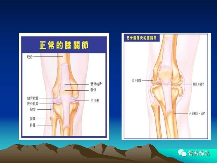 膝关节骨性关节炎的认识和手术治疗