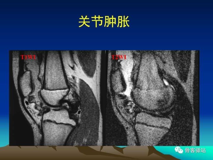 膝关节骨性关节炎的认识和手术治疗