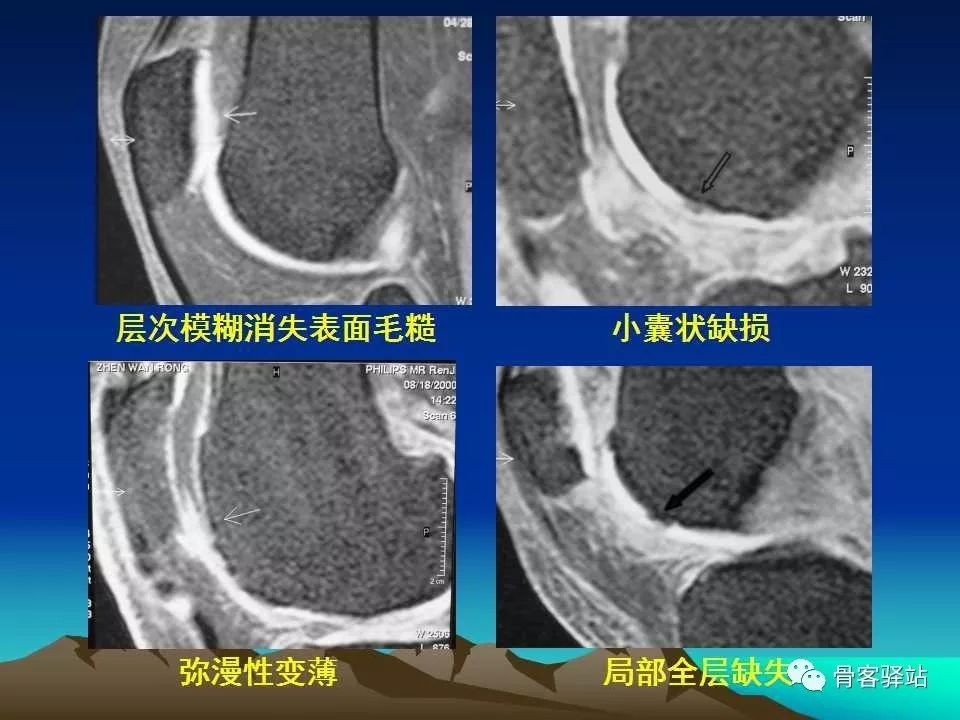 膝关节骨性关节炎的认识和手术治疗