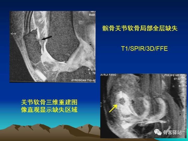 膝关节骨性关节炎的认识和手术治疗