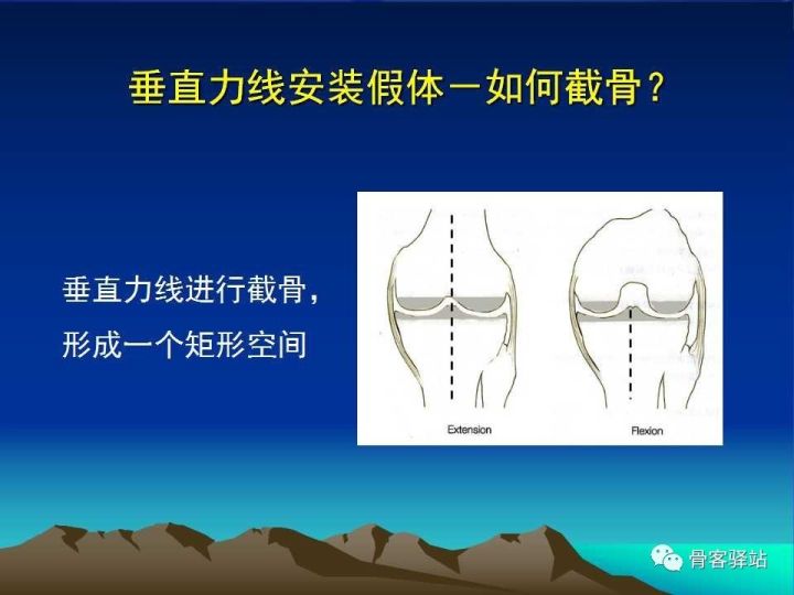 膝关节骨性关节炎的认识和手术治疗