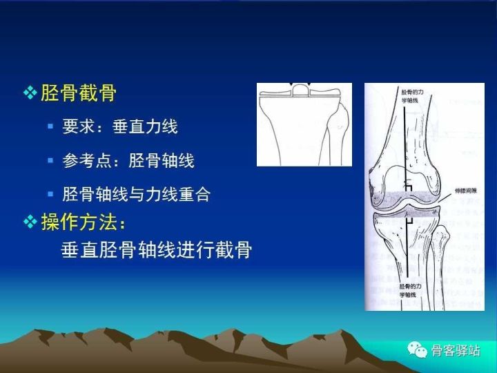 膝关节骨性关节炎的认识和手术治疗