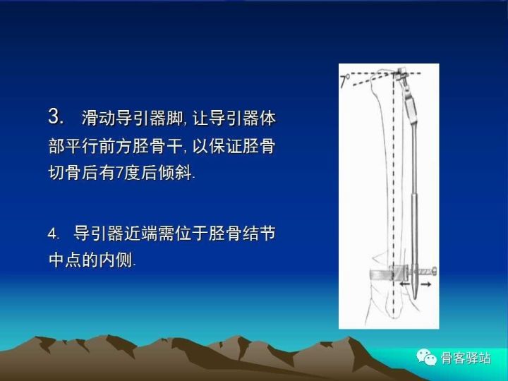 膝关节骨性关节炎的认识和手术治疗