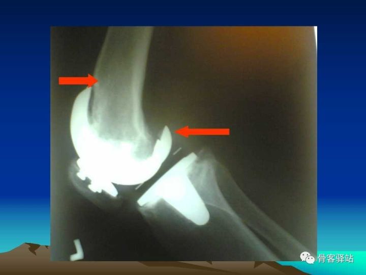 膝关节骨性关节炎的认识和手术治疗
