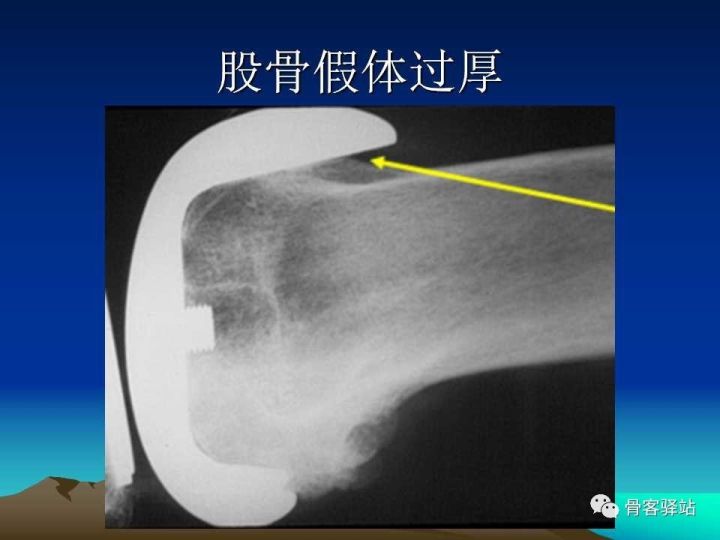 膝关节骨性关节炎的认识和手术治疗