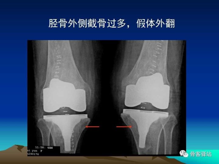 膝关节骨性关节炎的认识和手术治疗