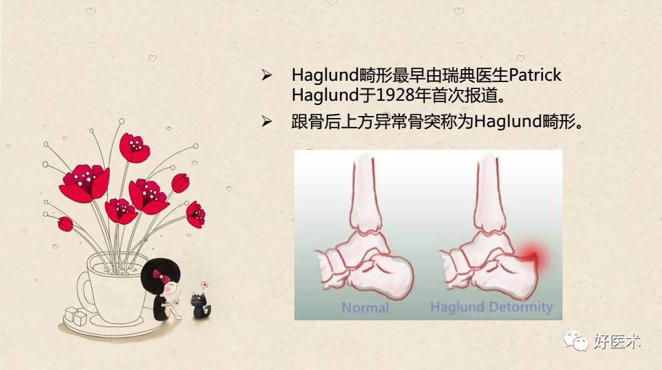 关节镜微创治疗Haglund综合征
